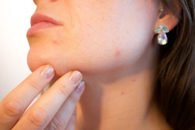 things that can cause acne
